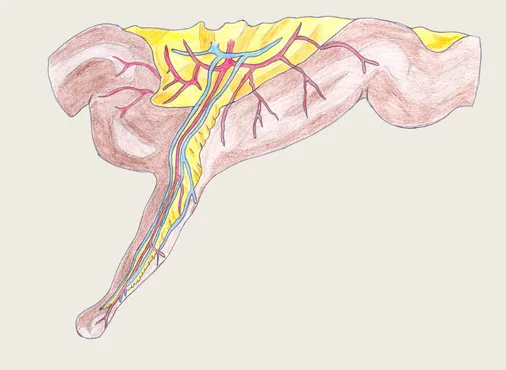 Meckel's Diverticulum consultation at Niraaya Hospital